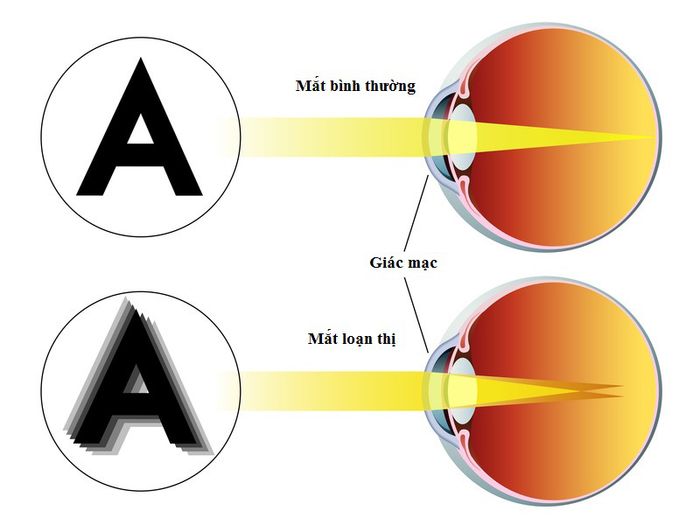 Tia sáng khi đi qua võng mạc của mắt bị loạn thị sẽ tạo ra hình ảnh không rõ nét.