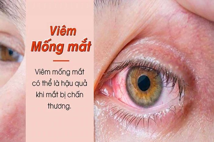 Các yếu tố gây ra viêm mống mắt