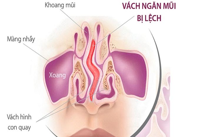 Lệch vách ngăn mũi cũng làm tăng nguy cơ bị bệnh