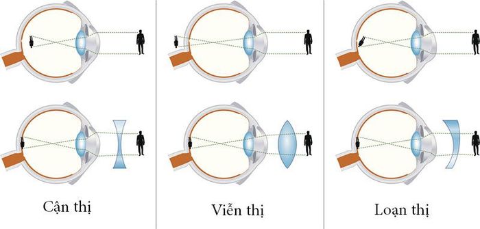 Hình ảnh của các vật thể được phản chiếu trên mắt của những người mắc phải tình trạng khúc xạ