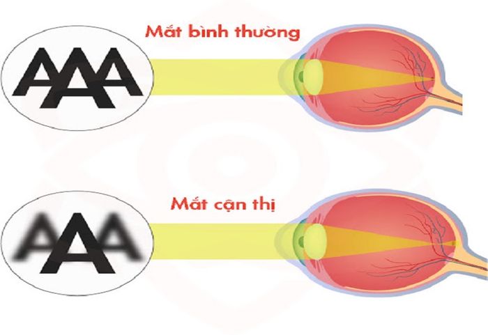 Mắt bị cận không thể nhìn rõ xa