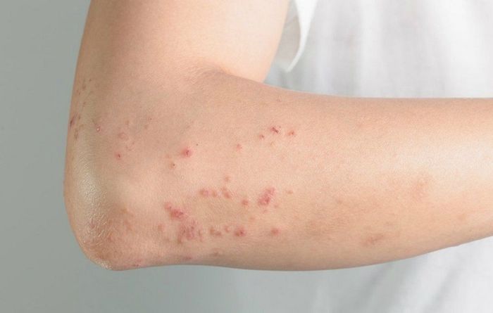 Mẹ Bầu Nhiễm Rubella Trong Thai Kỳ và Hậu Quả Tới Thai Nhi