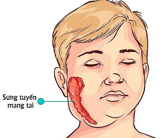 Sưng đau tuyến nước bọt là dấu hiệu đặc trưng của bệnh quai bị