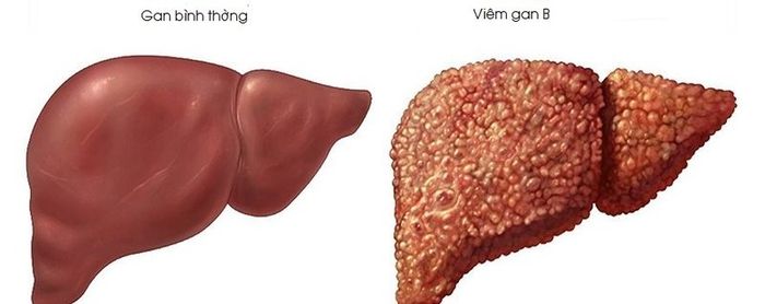 Viêm gan B có thể phát triển thành giai đoạn cấp tính, mạn tính và có thể gây ra các biến chứng như xơ gan, ung thư gan.