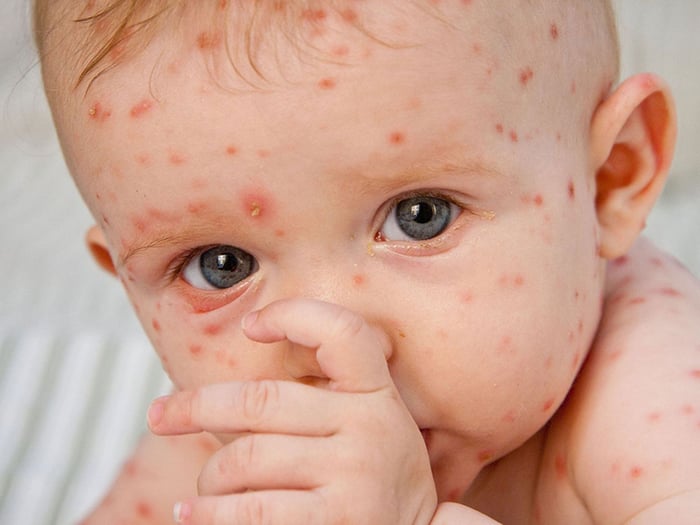 Việc tiêm phòng vắc xin MR là biện pháp hiệu quả nhất để ngăn ngừa bệnh sởi và rubella;