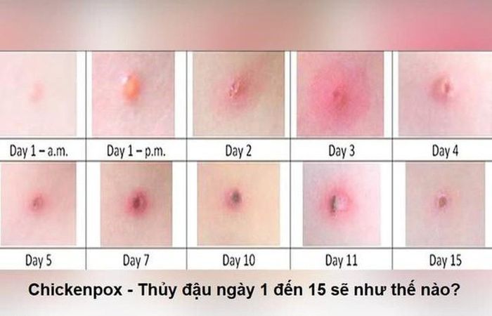 Sự phát triển của bệnh thủy đậu qua từng giai đoạn