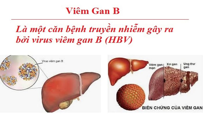 Viêm gan B có thể tiến triển thành bệnh mãn tính và đe dọa tính mạng