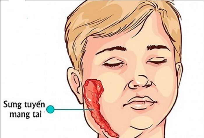 Các vị trí bị sưng là dấu hiệu cảnh báo về việc mắc bệnh quai bị