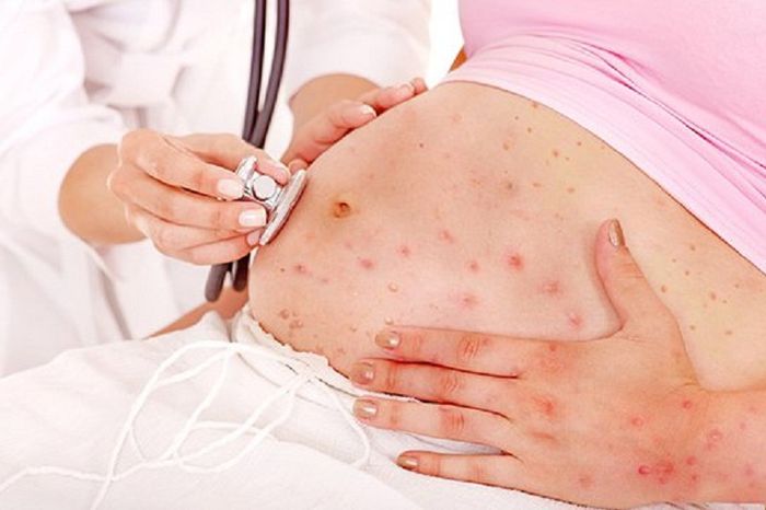 Bệnh Rubella Rất Nguy Hiểm Với Phụ Nữ Mang Thai