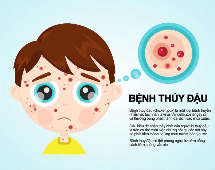 Bảo vệ bản thân khỏi bệnh thủy đậu bằng cách tiêm vắc xin