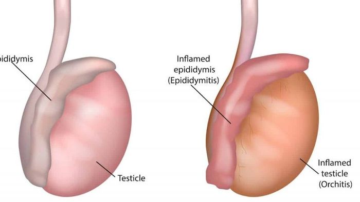 Khi bị viêm, nam giới có thể cảm thấy đau và sưng ở một hoặc hai bên tinh hoàn