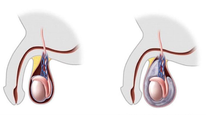 Dịch ứ đọng quá nhiều trong bìu dẫn đến bệnh thuỷ tinh mạc