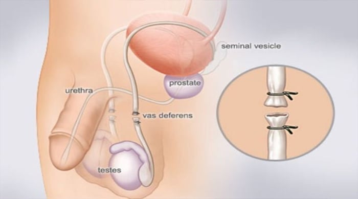 Sau khi thực hiện thủ thuật thắt ống dẫn tinh, vẫn có khả năng nối lại để có con