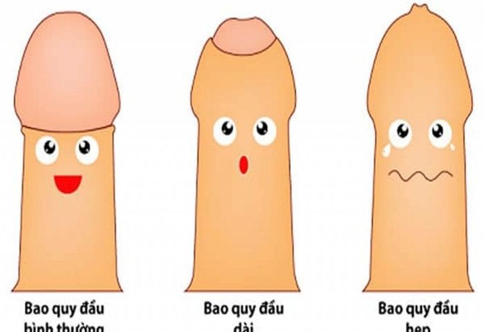 Phẫu thuật cắt bao quy đầu trong trường hợp bao quy đầu bị dài, hẹp