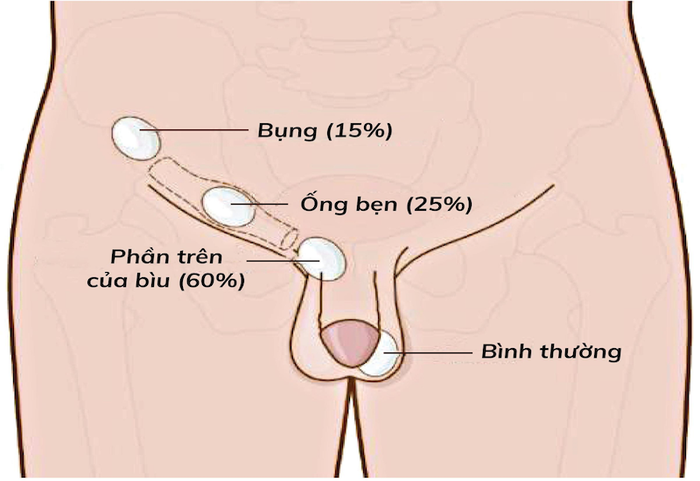 - Tinh hoàn ẩn: tinh hoàn không chuyển xuống bìu như thường, mà nằm ở vị trí khác (lỗ bẹn nông, lỗ bẹn sâu, ống bẹn, trong ổ bụng).