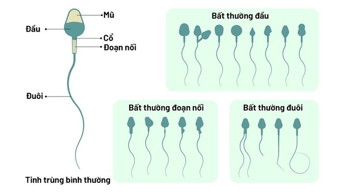 So sánh giữa tinh trùng bình thường và tinh trùng khuyết tật