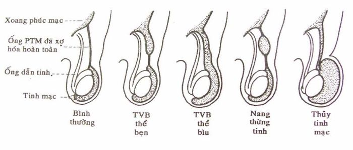 Tình trạng bình thường và các bệnh lý của ống tinh hoàn mô