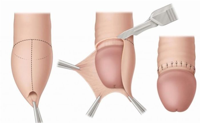 Cắt bao quy đầu là một tiểu phẫu đơn giản, được thực hiện nhanh chóng