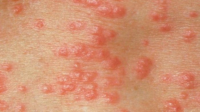 Herpes sinh dục