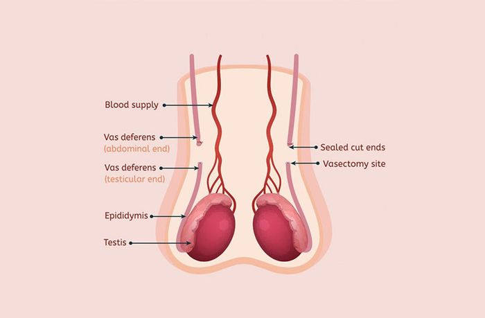 Thắt ống dẫn tinh - một phương pháp triệt sản dành cho nam giới