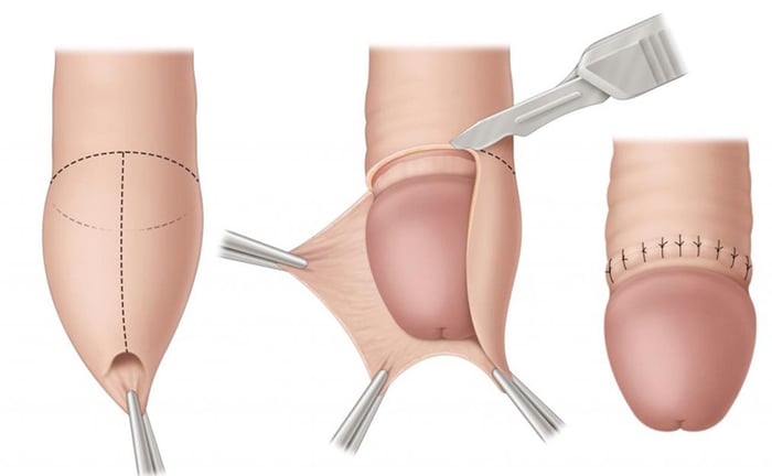 Mô phỏng phẫu thuật cắt bao quy đầu