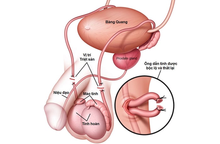 Quy trình thắt ống dẫn tinh