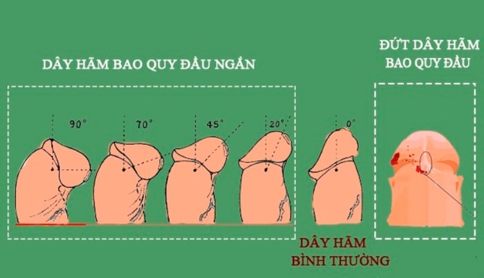 Nguyên Nhân Của Đứt Dây Hãm Bao Quy Đầu