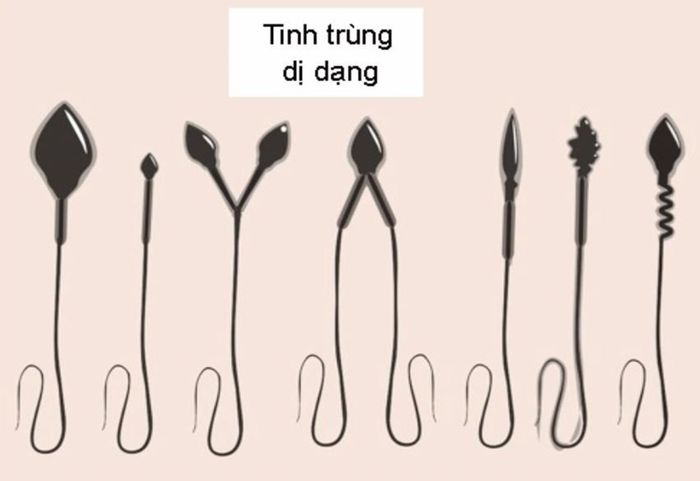 Tinh trùng biến dạng ảnh hưởng đến khả năng sinh sản của nam giới