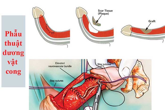 Dương vật cong mức độ nghiêm trọng có thể được chỉ định phẫu thuật để nắn thẳng