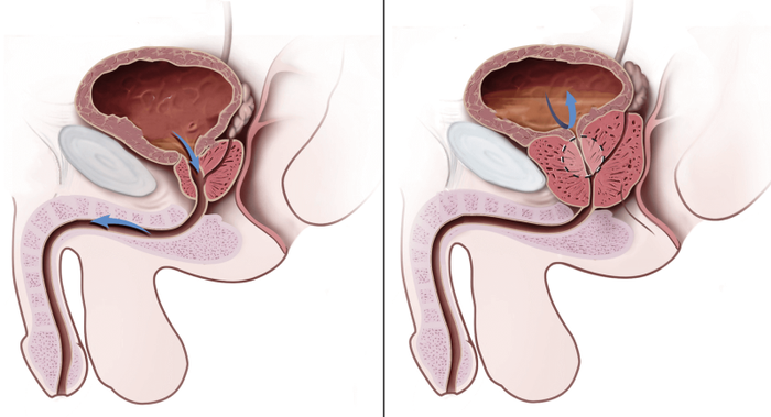 Sự phình to của tuyến tiền liệt gây áp lực lên niệu đạo