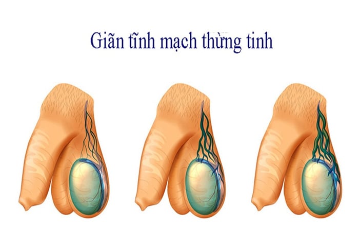 Tình trạng mạch máu nổi lên ở tinh hoàn