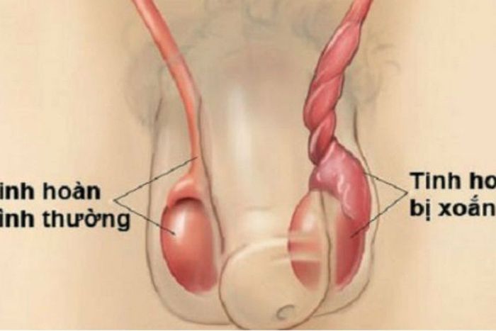 Rủi ro của xoắn tinh hoàn ở trẻ em