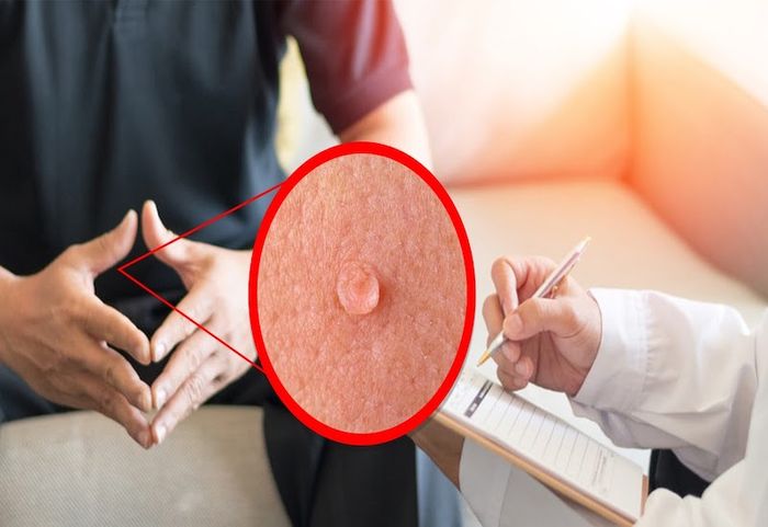 Bệnh sùi mào gà ở nam là một vấn đề phổ biến, do virus HPV gây ra