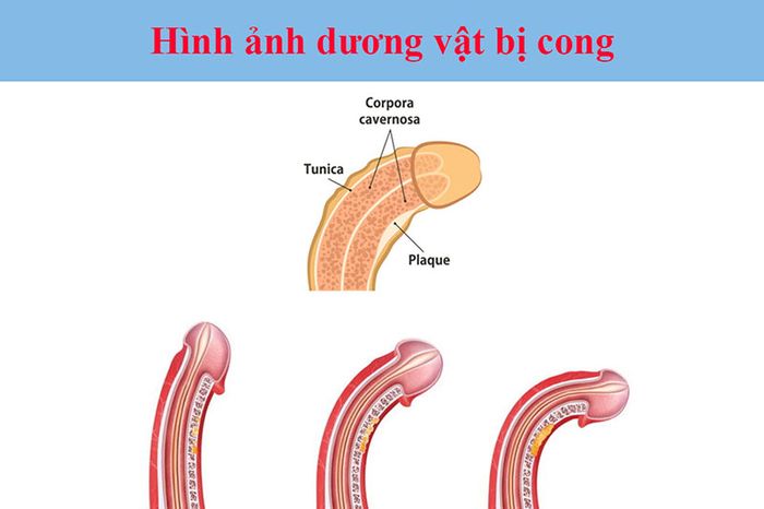 Dương vật bị cong là khi dương vật lệch hẳn sang một bên hoặc chúc xuống dưới khi đang cương cứng