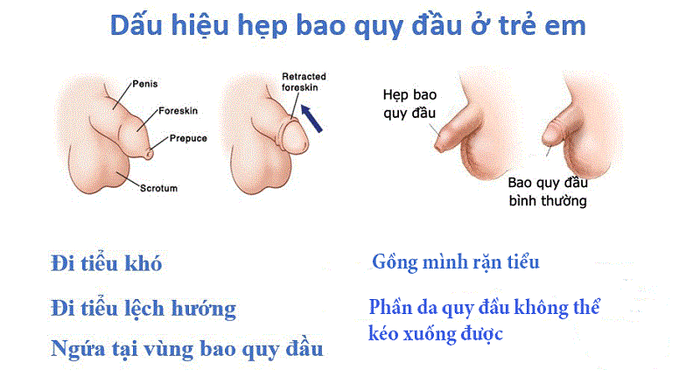 Triệu chứng và mức độ của hẹp bao quy đầu ở trẻ em có thể đa dạng.