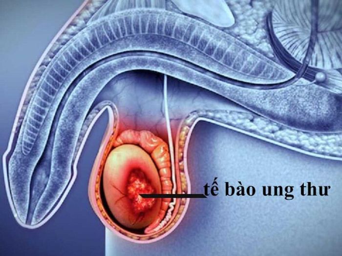 Phẫu thuật cắt bỏ tinh hoàn thường được thực hiện để điều trị ung thư tinh hoàn