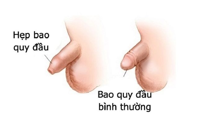 Hẹp bao quy đầu gây phiền toái không chỉ trong việc tiểu tiện mà còn ảnh hưởng đến cuộc sống hôn nhân.