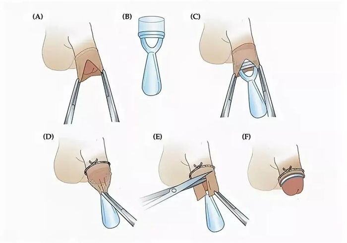 Hình minh họa về quá trình cắt bao quy đầu ở nam giới