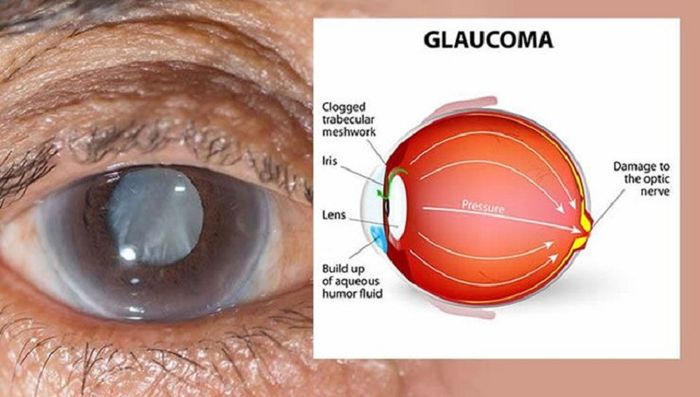 Mắt mờ đột ngột vì tăng áp lực trong mắt