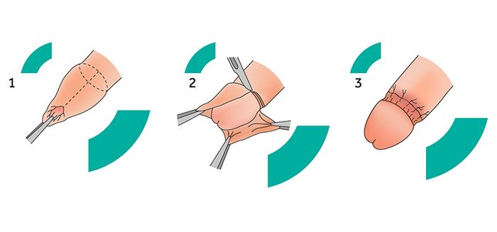 Phẫu thuật cắt bao quy đầu có thể được thực hiện cho cả người lớn và trẻ em.