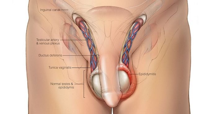 Viêm tinh hoàn là nguyên nhân khiến một bên tinh hoàn bị đau và sưng to.