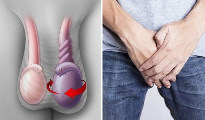 Xoắn tinh hoàn không điều trị kịp thời gây ra các biến chứng nghiêm trọng như hoại tử, teo tinh hoàn