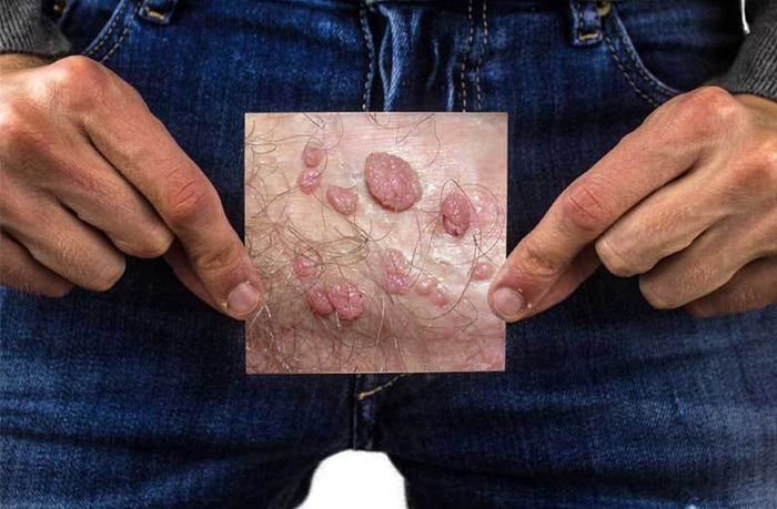 bệnh sùi mào gà ở nam giới