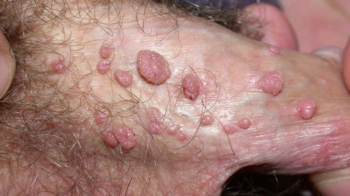 bệnh sùi mào gà ở nam giới