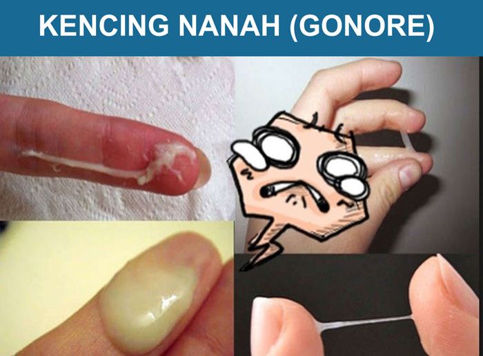 bệnh lậu ở nam giới