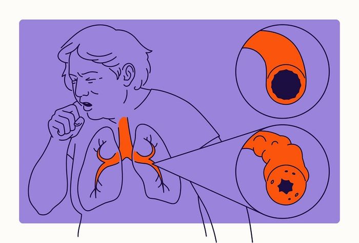 Ho liên tục và khó thở là dấu hiệu của bệnh phổi tắc nghẽn mạn tính