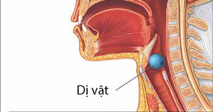 Dị vật đường thở có thể xuất hiện ở khí quản, thực quản hoặc phế quản
