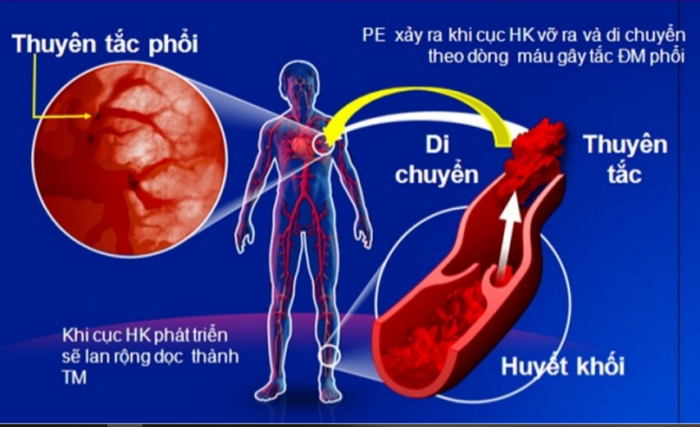 Quá trình phát triển bệnh phù phổi
