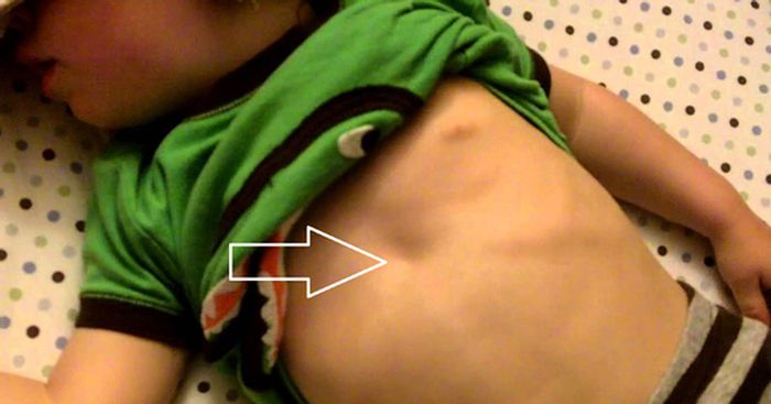 Dấu hiệu nhận biết bé thở ra bằng cách lõm vào lồng ngực