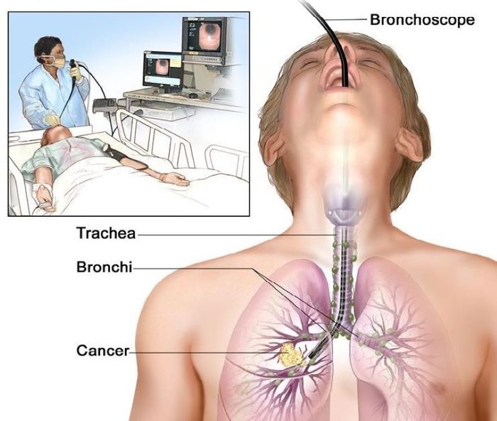 Nội soi phế quản giúp phát hiện các bất thường trong đường thở